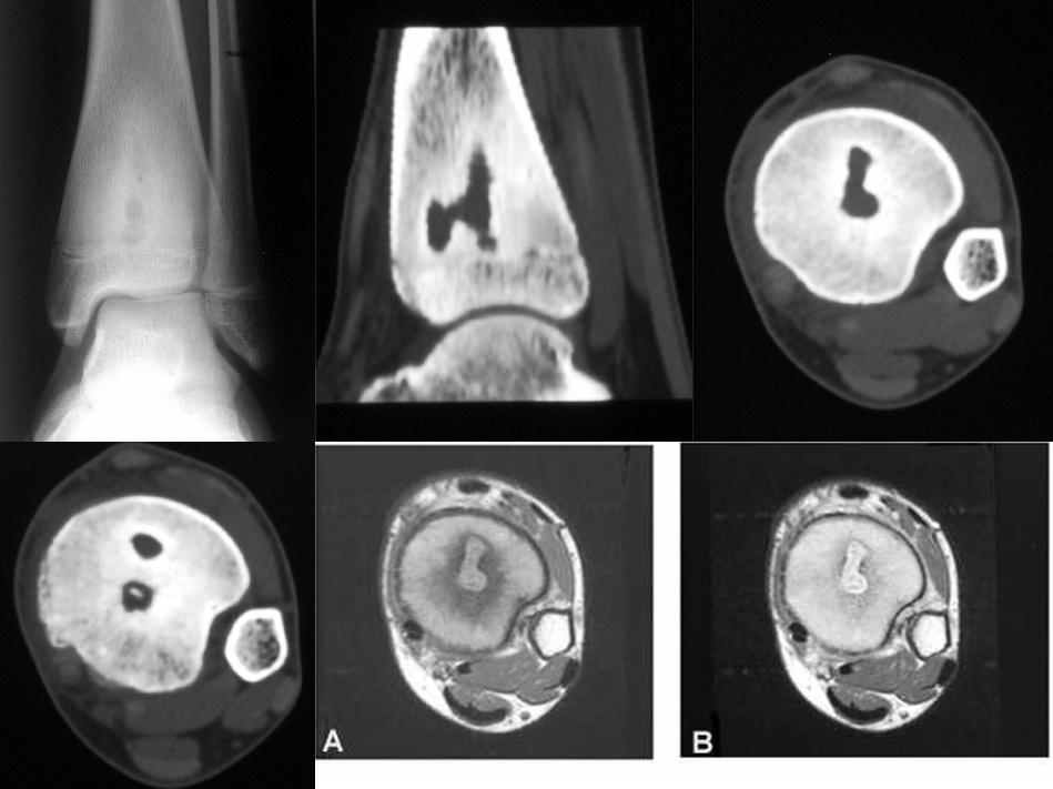 【讨论】胫骨病变(典型病例,影像资料超全,结果已经公布!