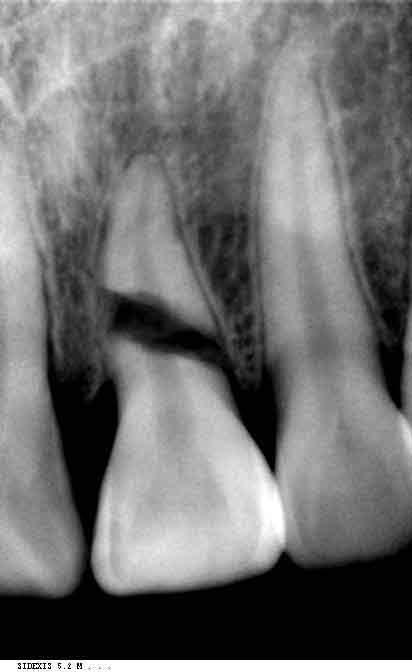 分享各类型牙折的x光片