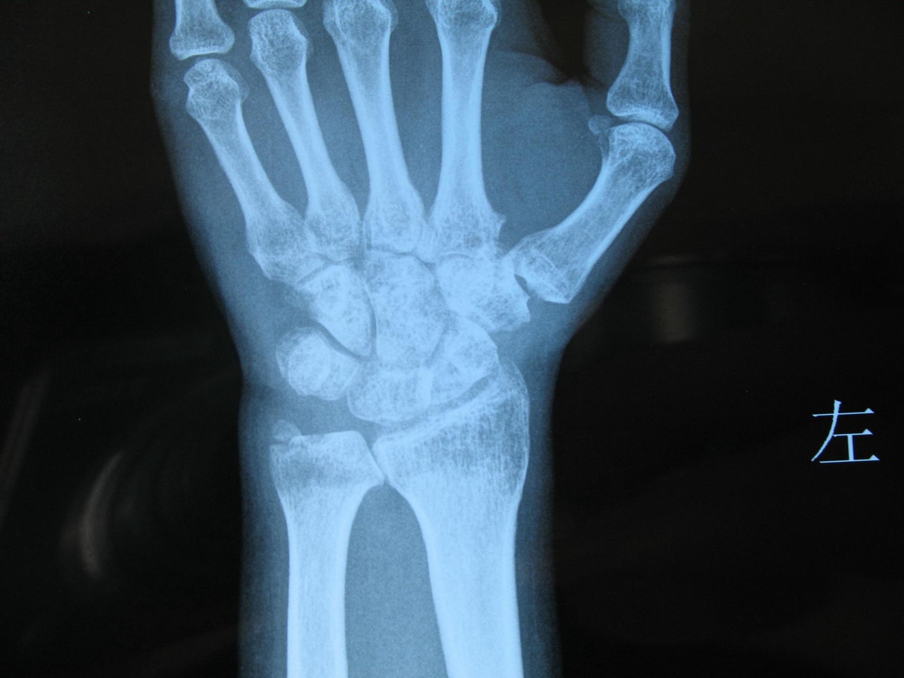 正常的手腕骨骼x光图图片
