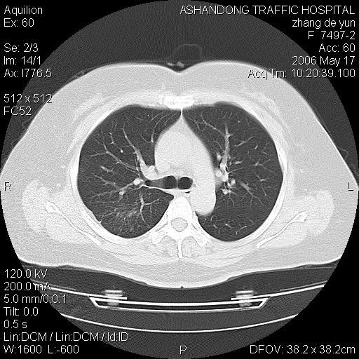 【討論】一個少見的肺ct片 - 醫學影像學討論版 - 愛愛醫醫學論壇