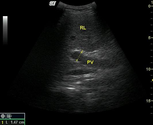 脾静脉超声图图片