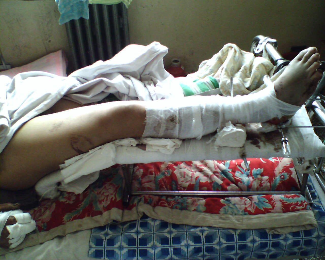 【病例讨论】患者多处骨折如何治疗?