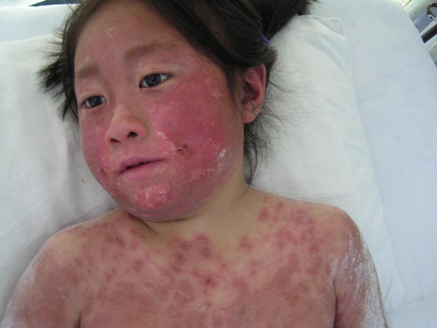 儿童eb病毒皮疹图片图片