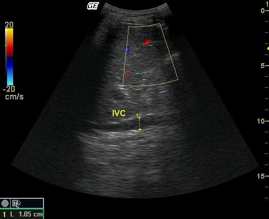 脾静脉超声图图片