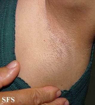 资源淋巴瘤图片