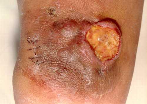 推荐恶性组织细胞增生症