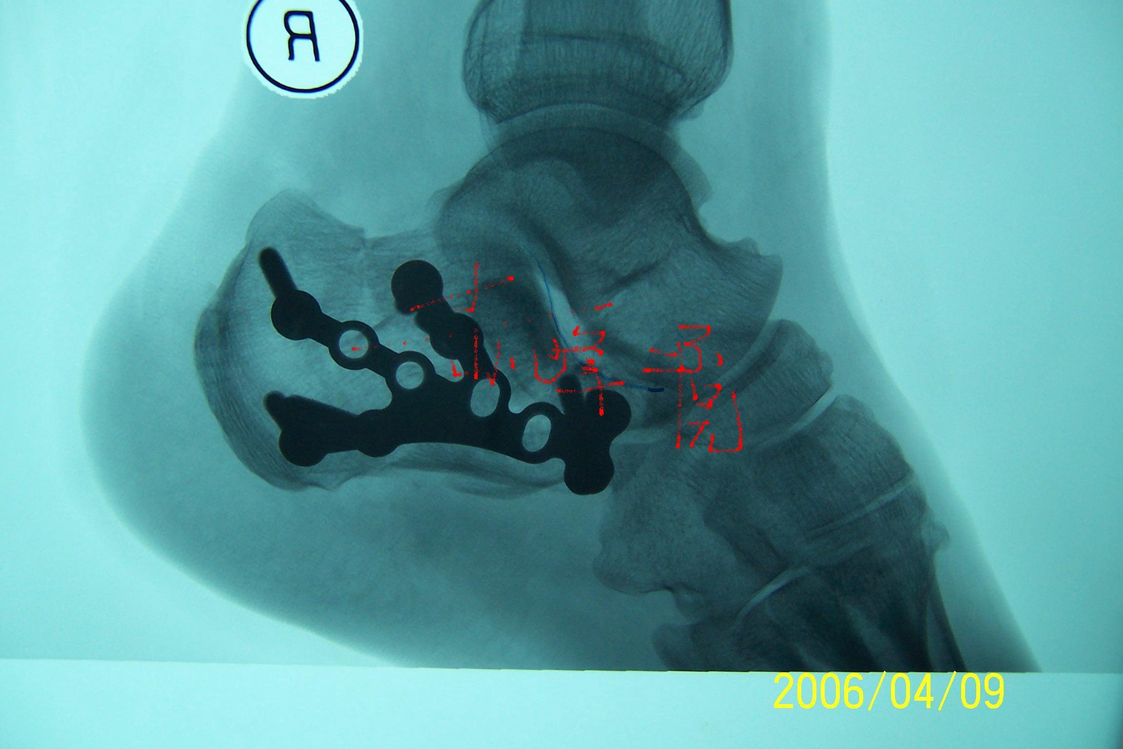 跟骨骨折用的钢板图片图片