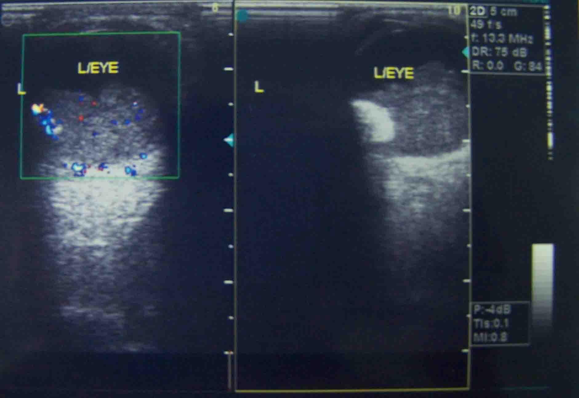 无性细胞瘤超声图像图片