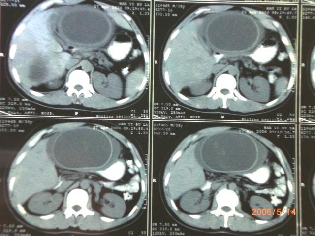 【原创】肝包虫ct片