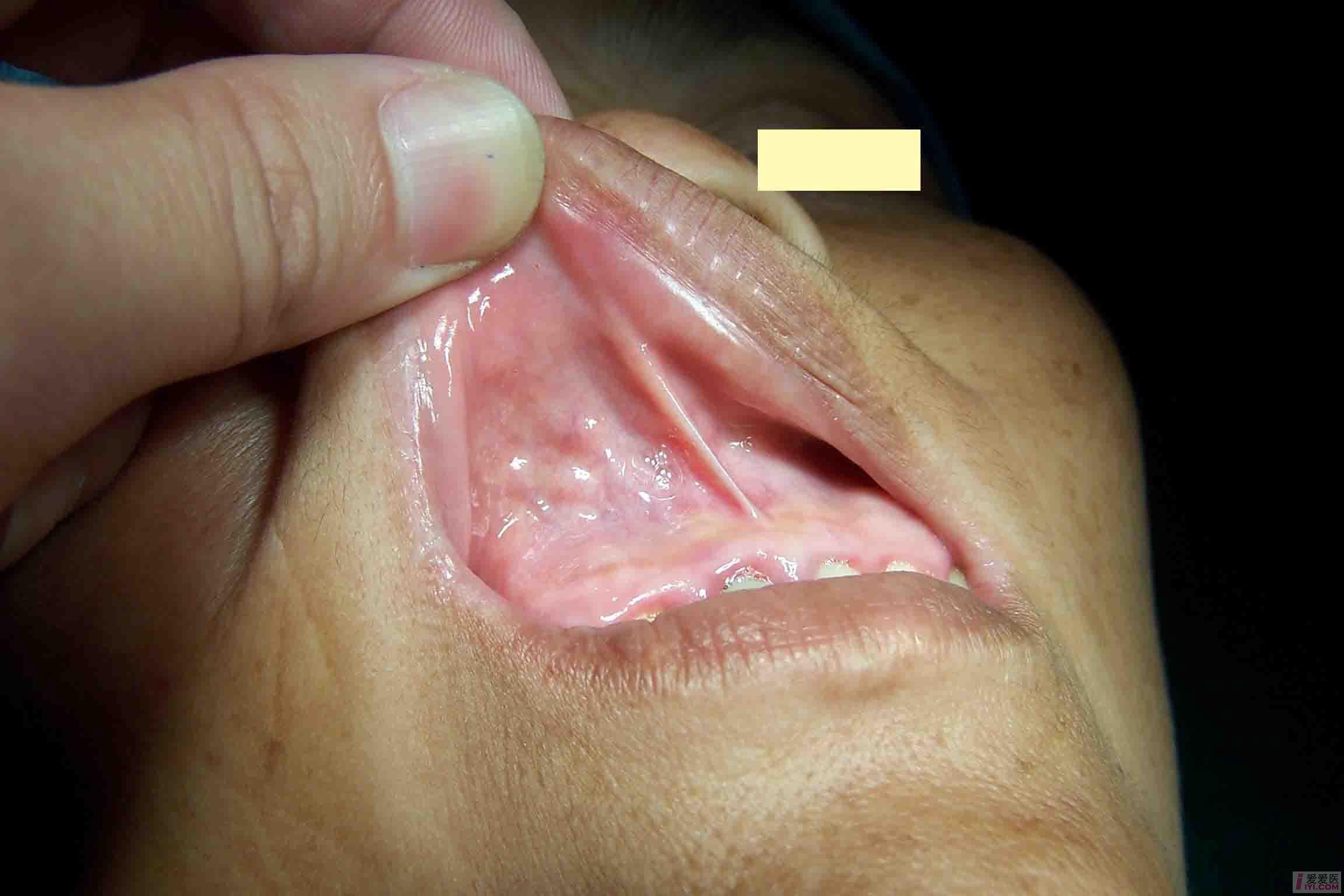 鼻前庭囊肿图片大全 搜狗图片搜索