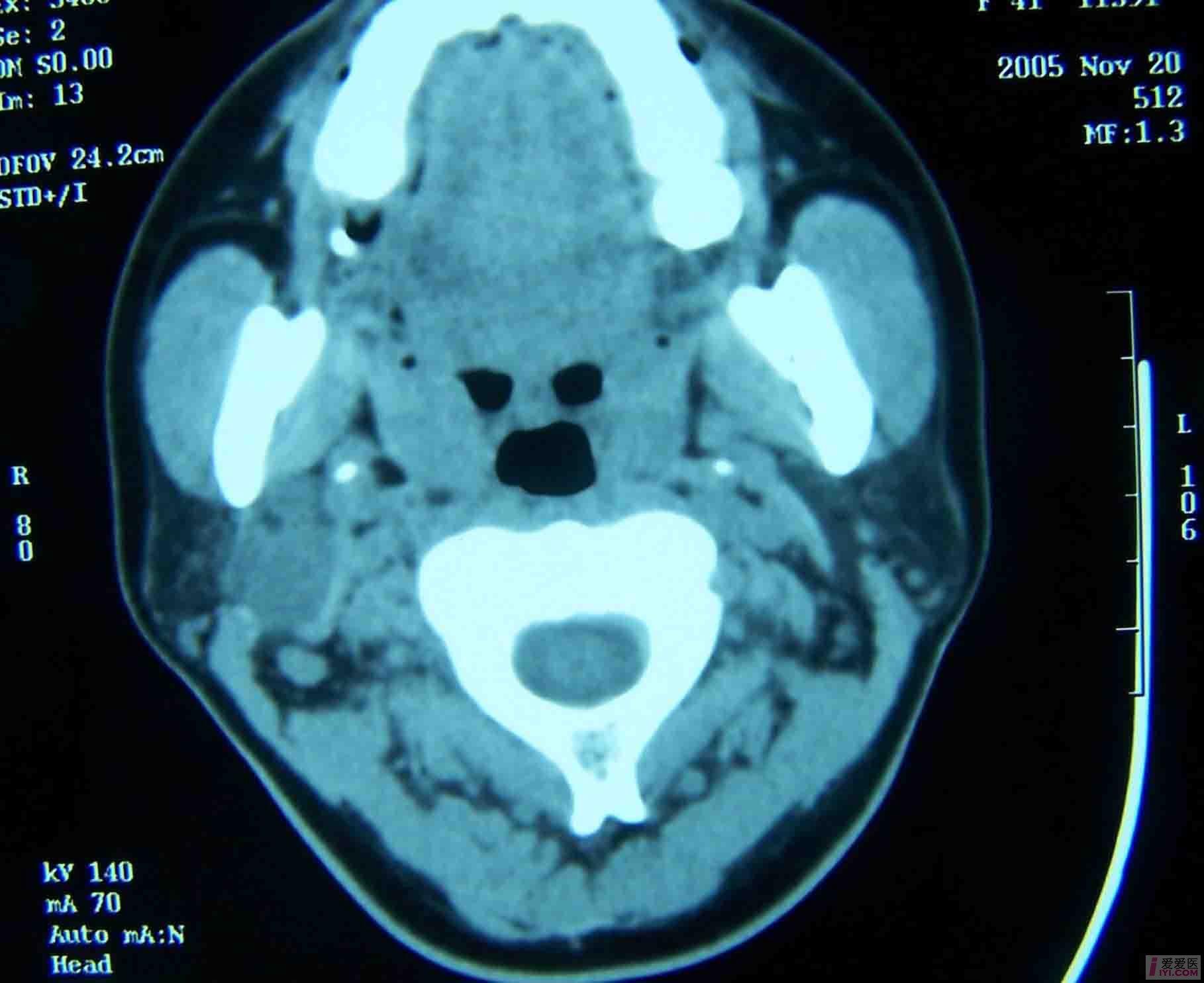 腮腺混合瘤超声表现图图片