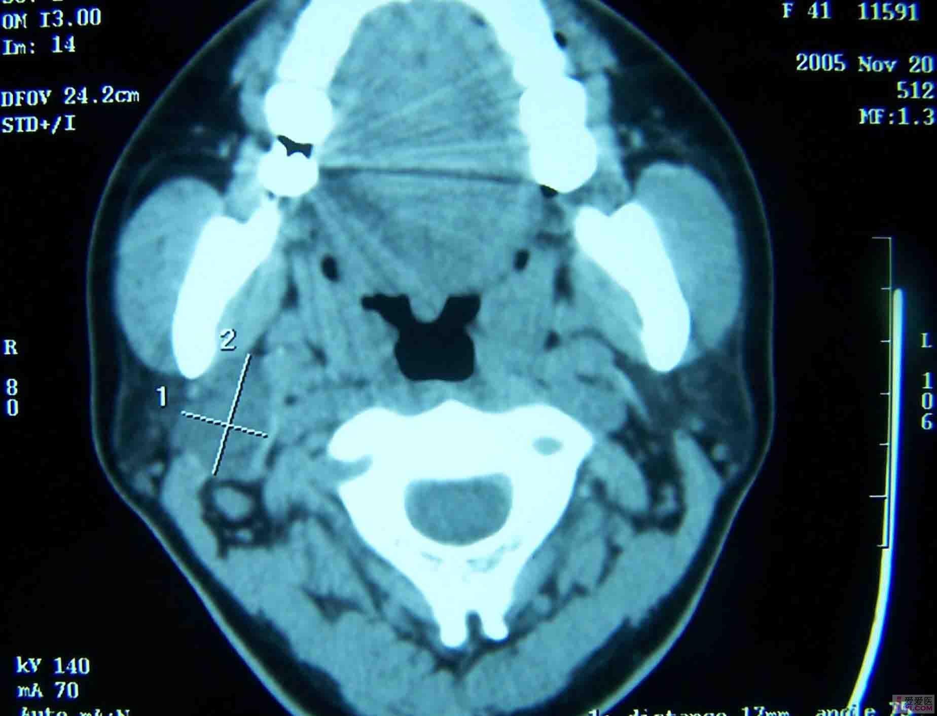腮腺混合瘤超声表现图片