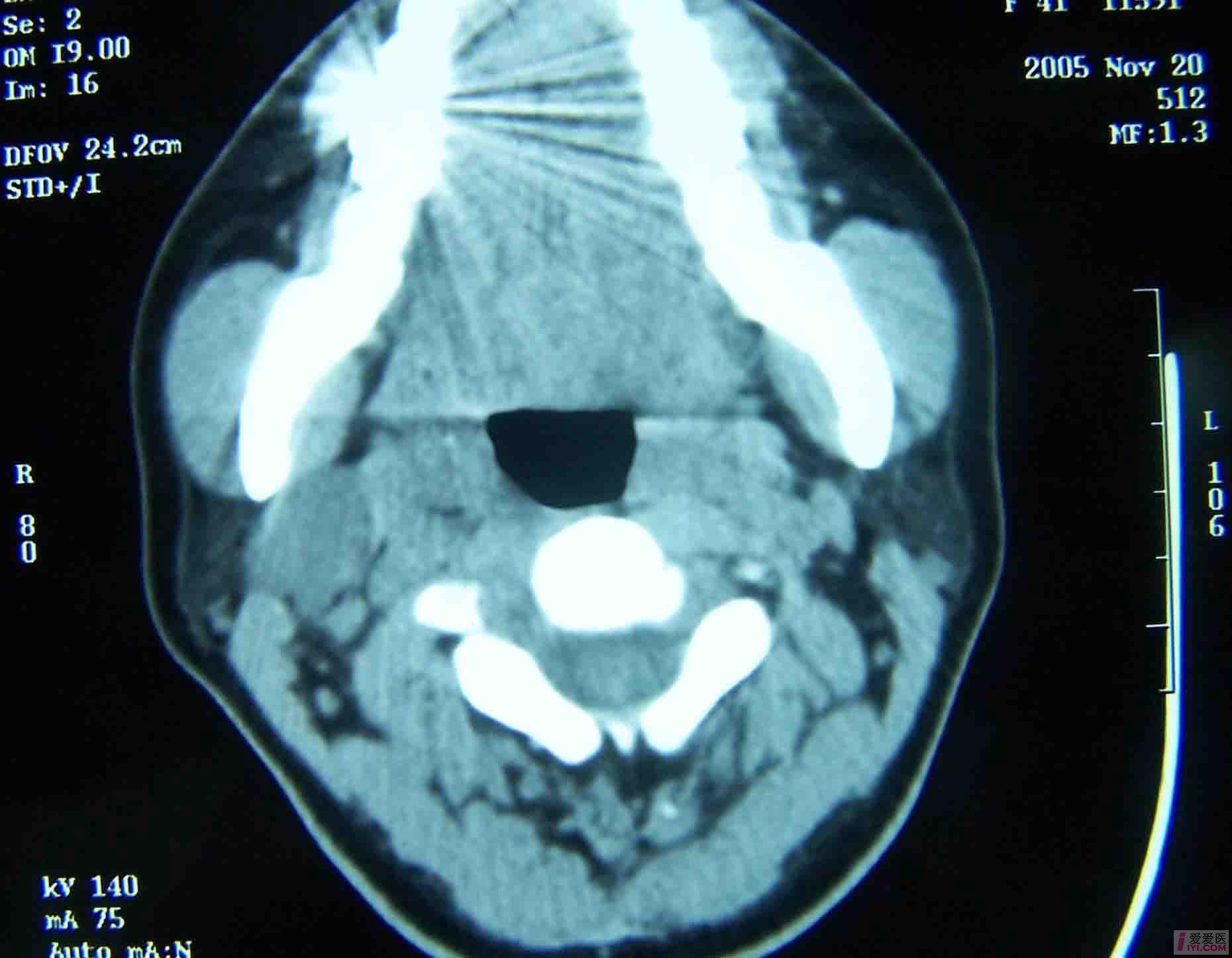 【原創】腮腺混合瘤一例