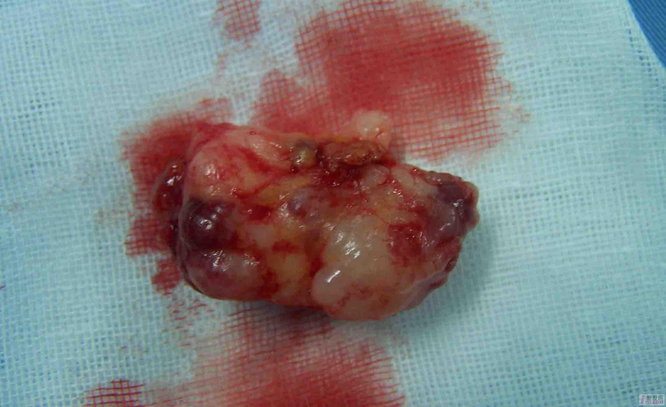 良性腮腺混合瘤图片图片