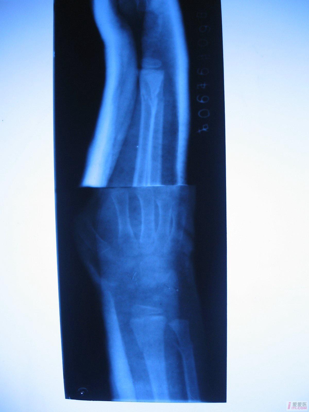 原创原创儿童尺桡骨下端骨折治疗方法