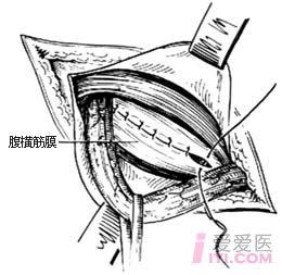 股疝的手术切口示意图图片