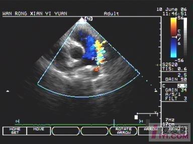 【分享】动脉导管未动闭 超声医学讨论版 爱爱医医学论坛