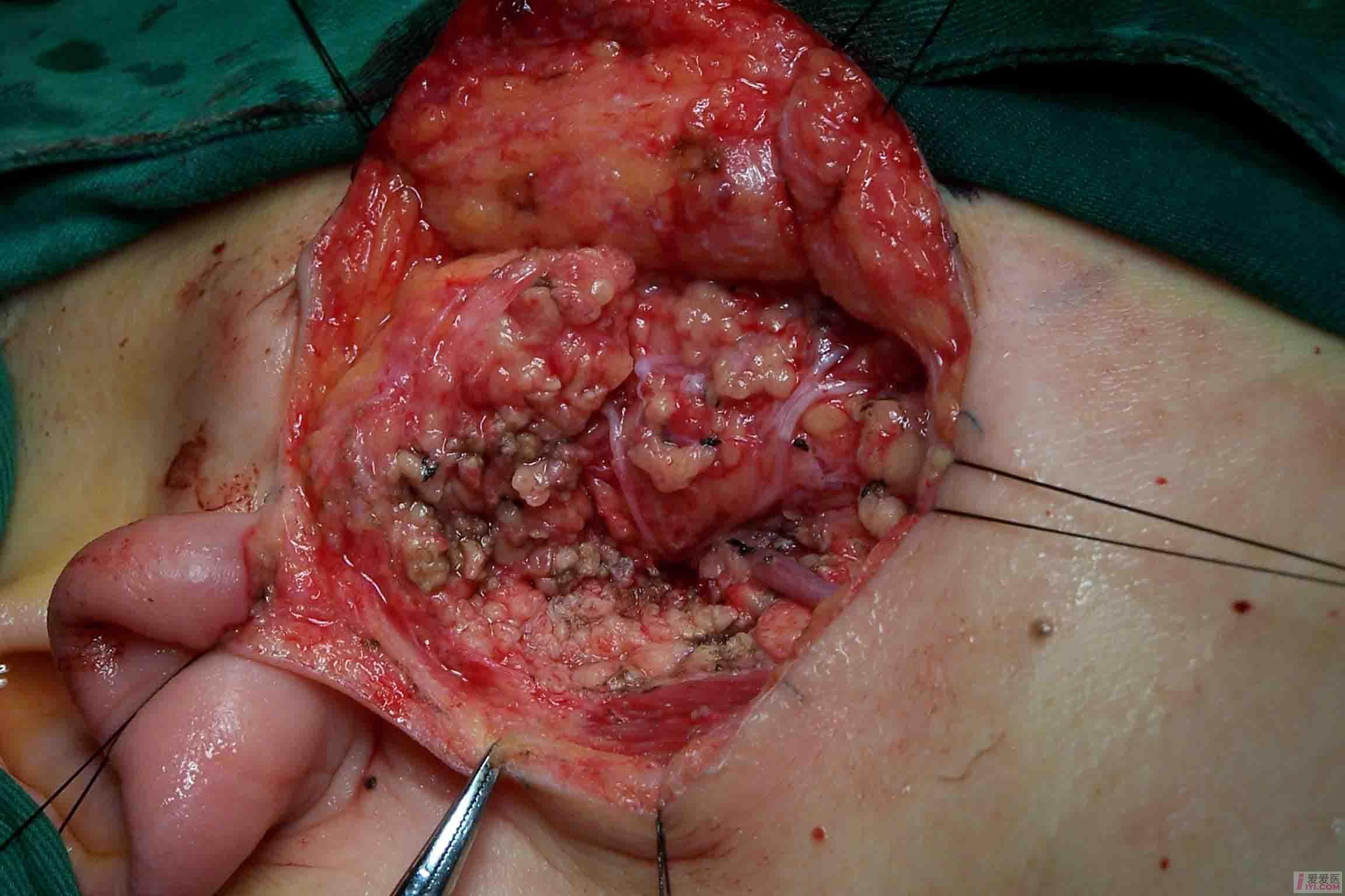 腮腺混合瘤恶性图片