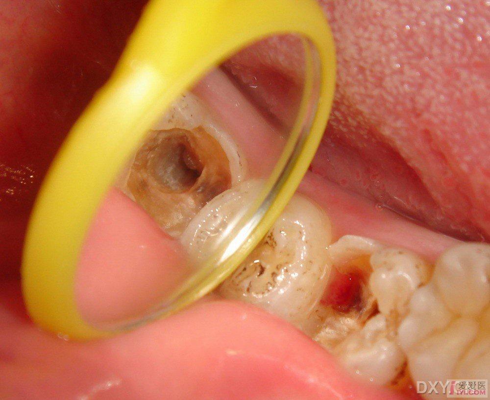 下颌第二磨牙c形根管