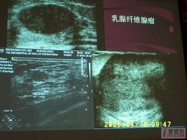 【贴图】乳腺纤维瘤