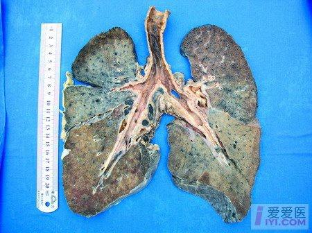 注意尘肺最严重的职业病