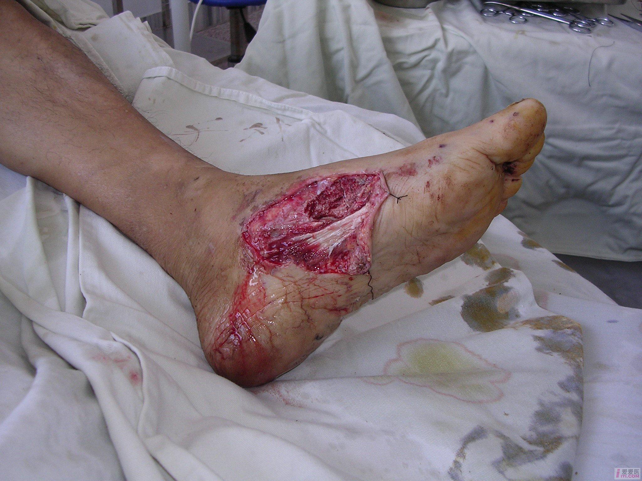 左脚软组织损伤照片图片