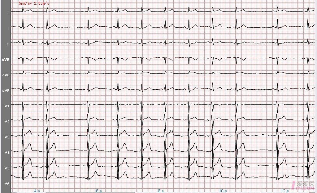 窦性心律心电图特点图片