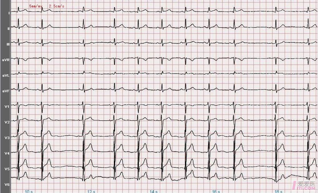 窦房传导阻滞心电图图片