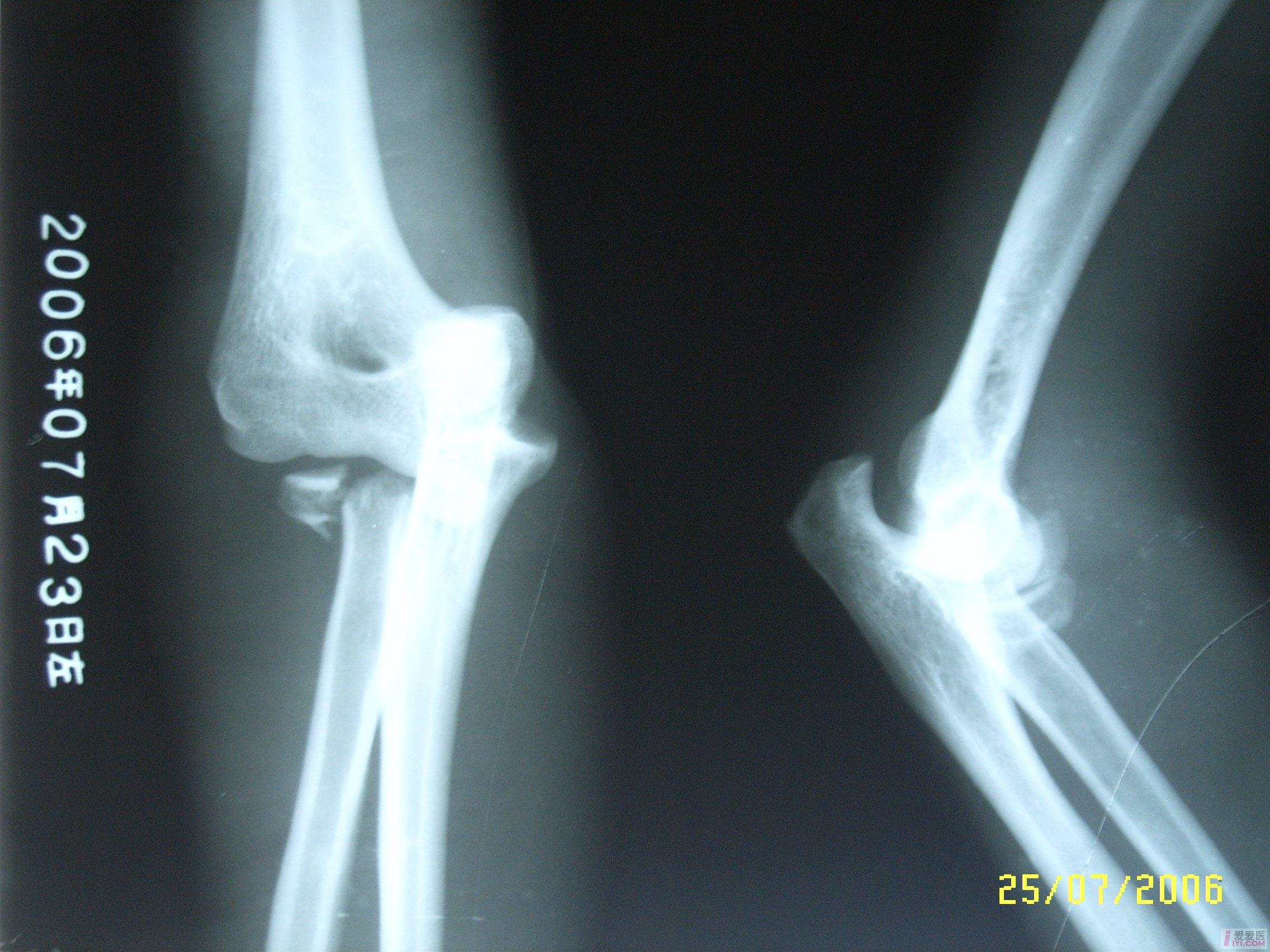 肘关节脱臼错位图片 搜狗图片搜索