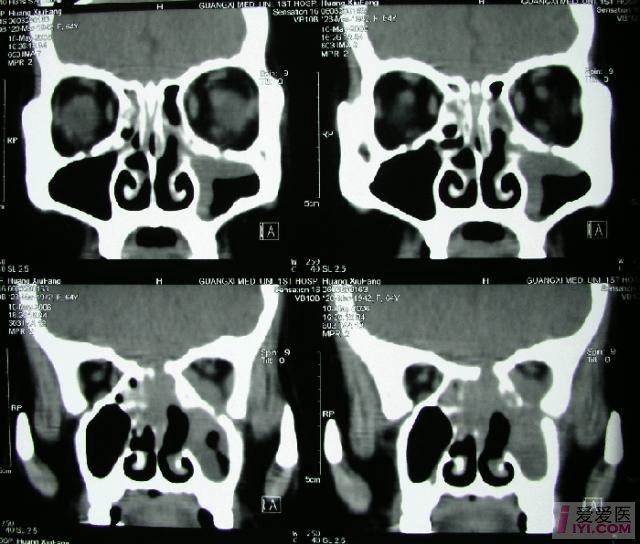 分享鼻竇腫瘤ct圖