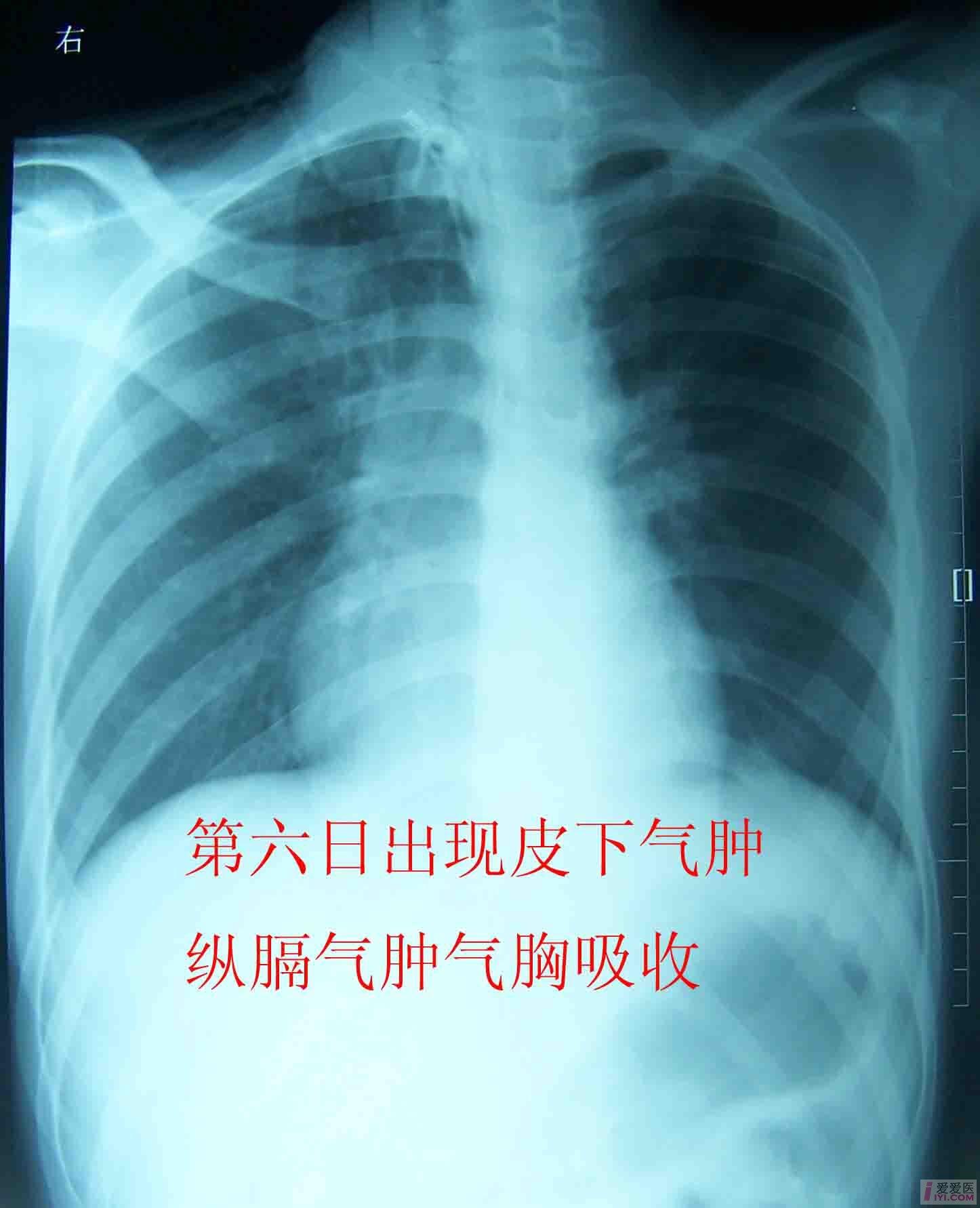 肺气肿的症状图片图片