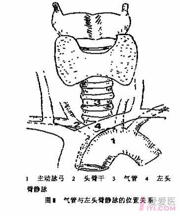 气管切开位置体表定位图片