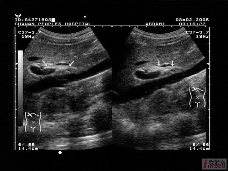 【讨论】【贴图】胆道蛔虫?