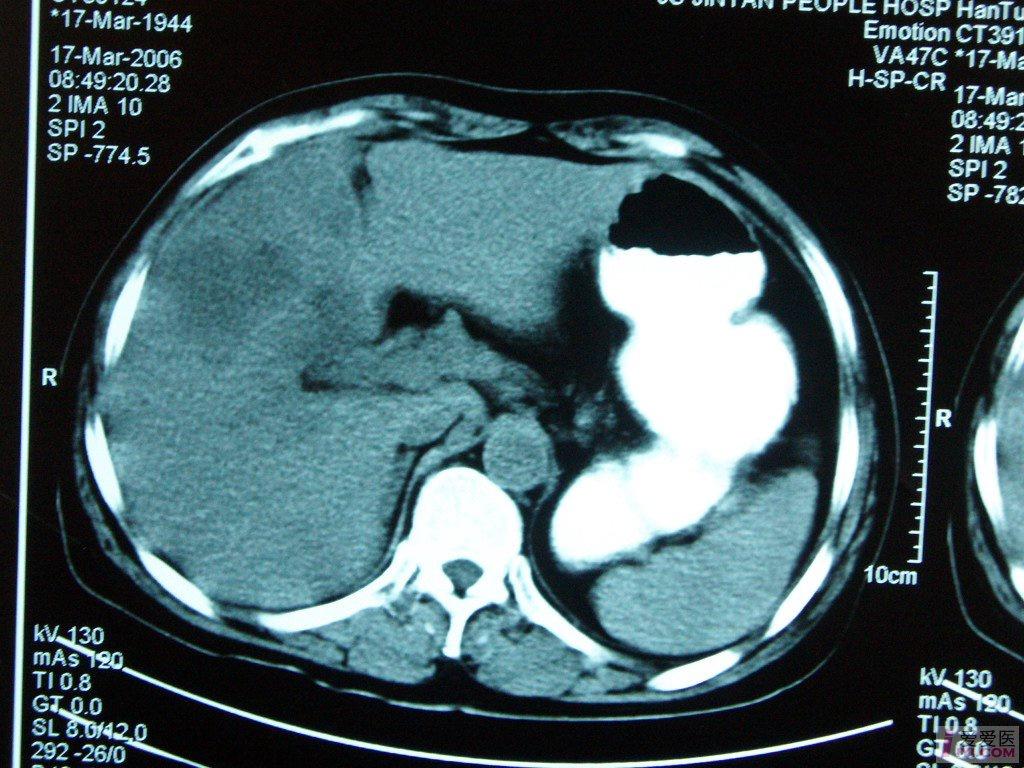 彩超胆管癌声像图片图片
