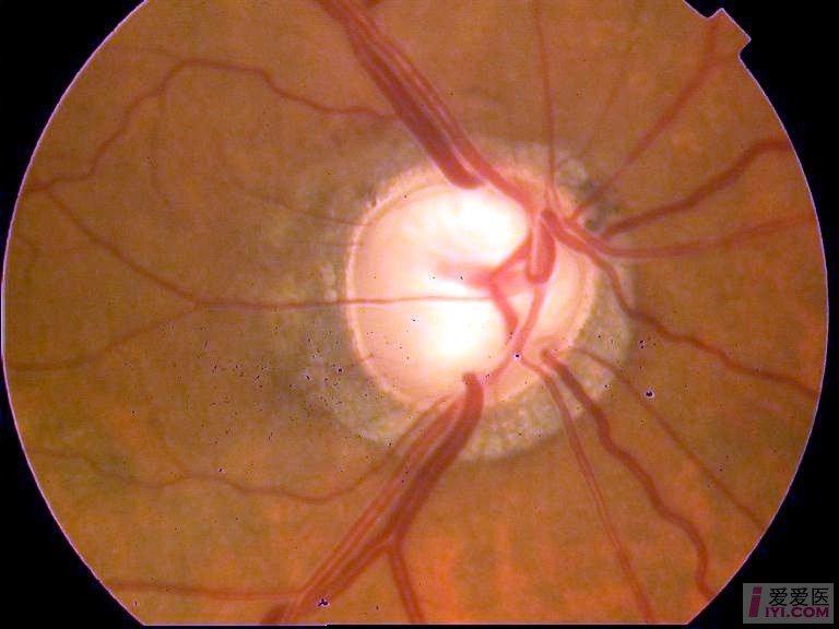 晚期青光眼视神经萎缩.jpg