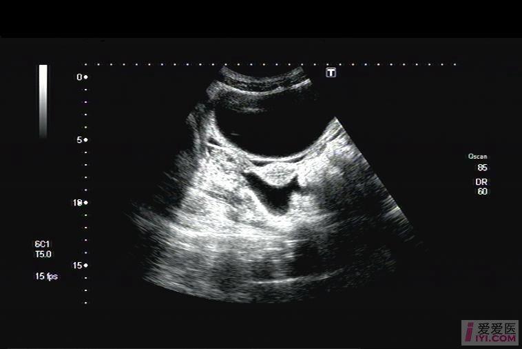 【贴图】盆腔积液中的子宫 超声医学讨论版 爱爱医医学论坛