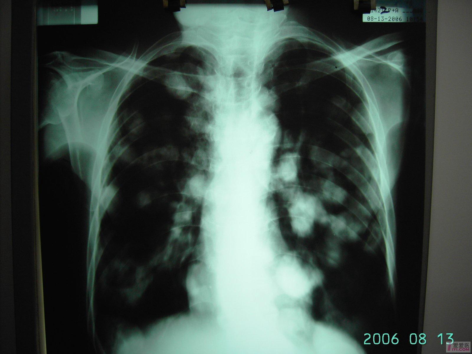 原创颈部恶性肿瘤晚期肺转移
