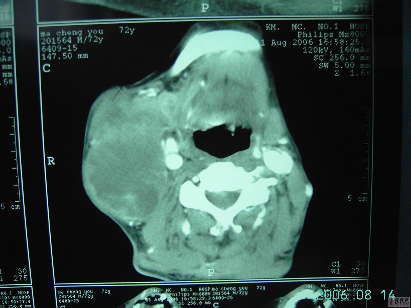原创颈部恶性肿瘤晚期肺转移