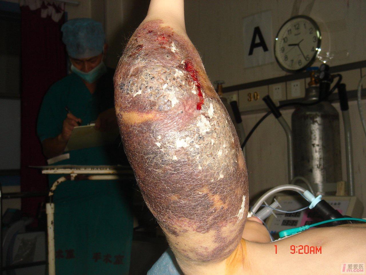 讨论刚收的一个巨大血管瘤患儿刚弄到图片看看吧