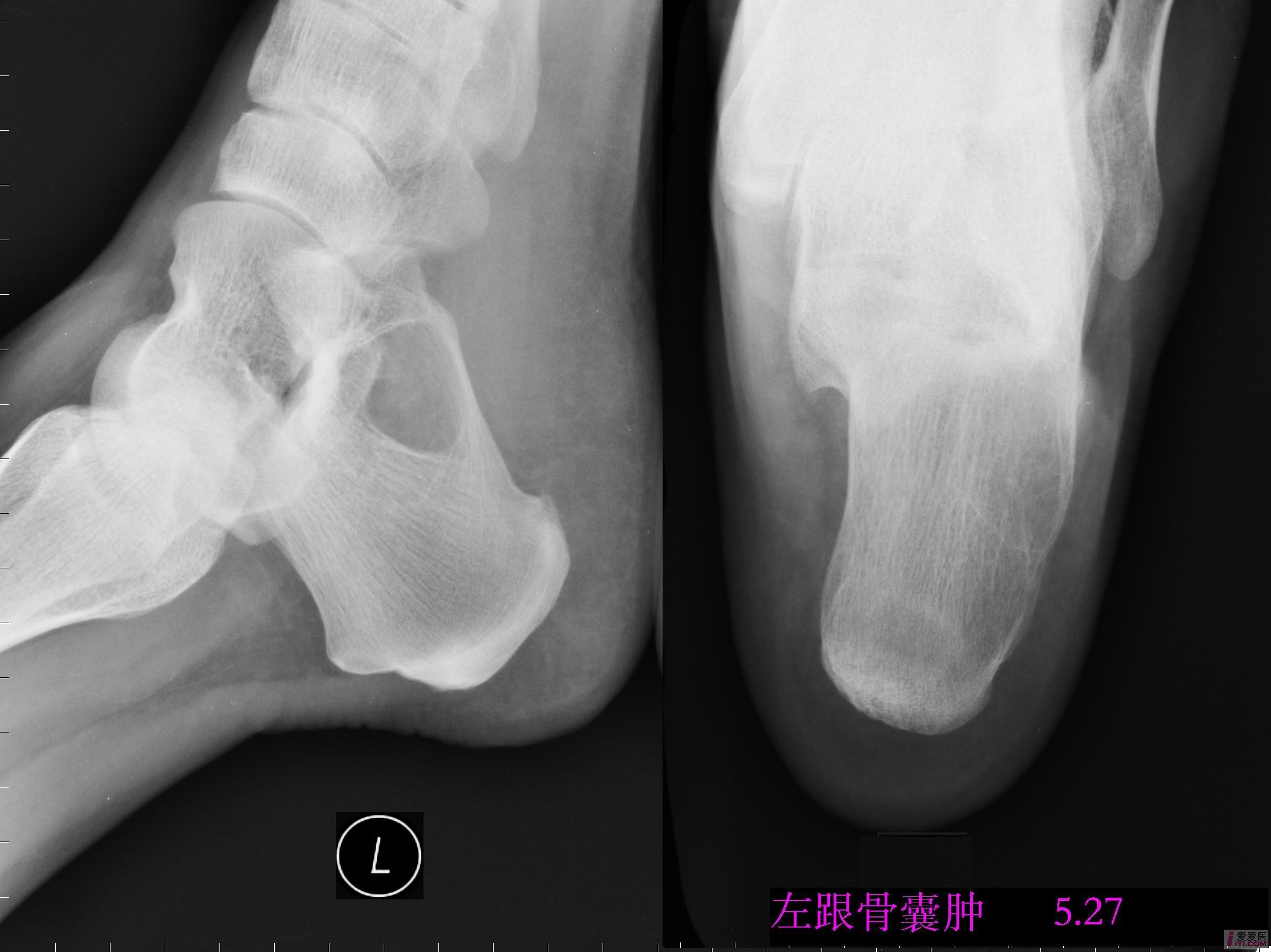 原創跟骨囊腫