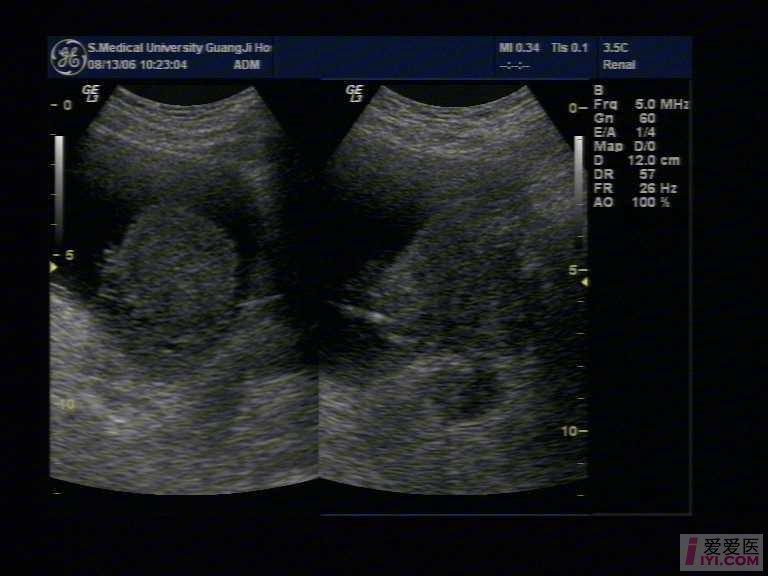 【原创】膀胱癌