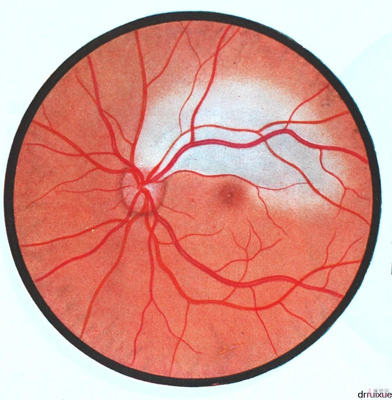 12.左眼视网膜颞上支动脉阻塞.JPG