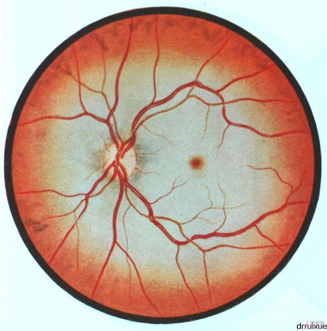 13.左眼视网膜中央动脉阻塞.JPG