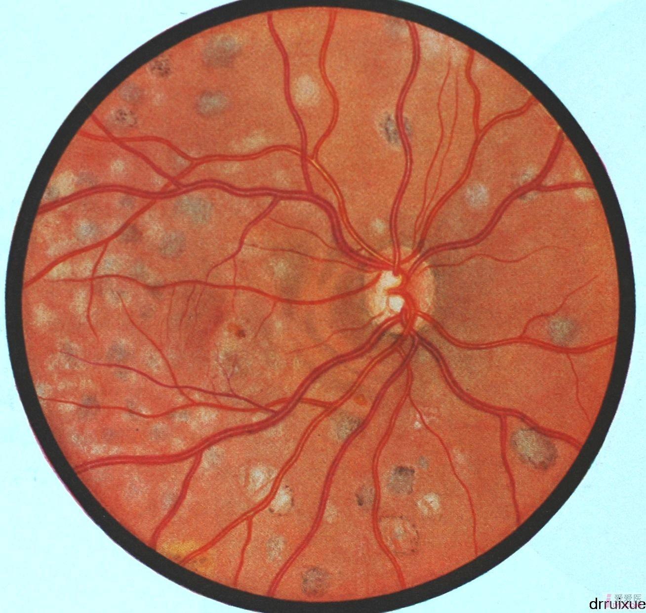 15结核性播散性脉络膜视网膜炎（退性期）.JPG