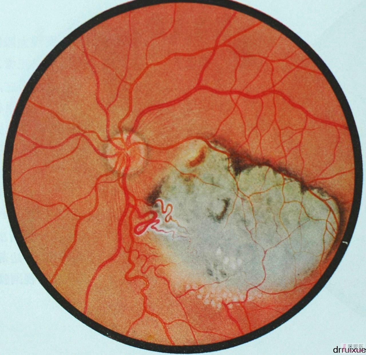 23.视网膜母细胞瘤（放射治疗后）.JPG