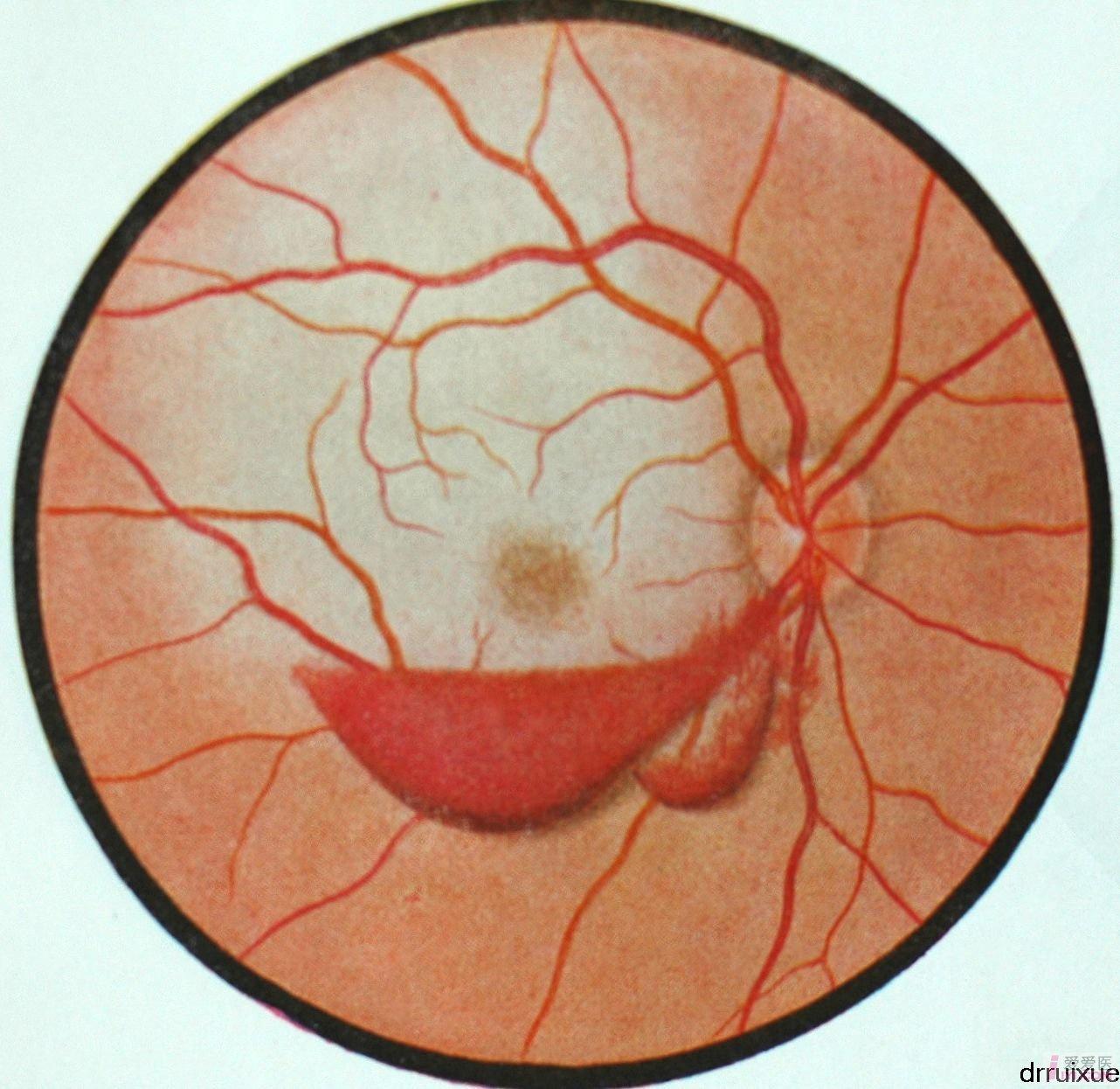 3.右眼外伤性视网膜前出血.JPG