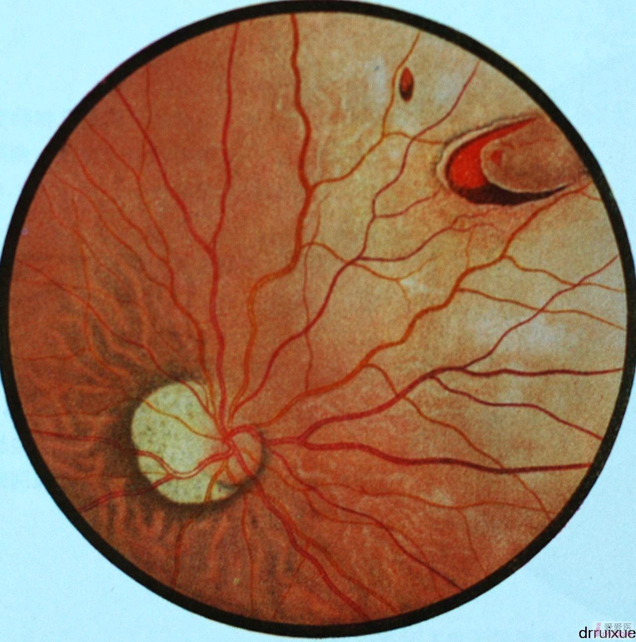 6.原发性视网膜脱离（马蹄形裂孔）.JPG