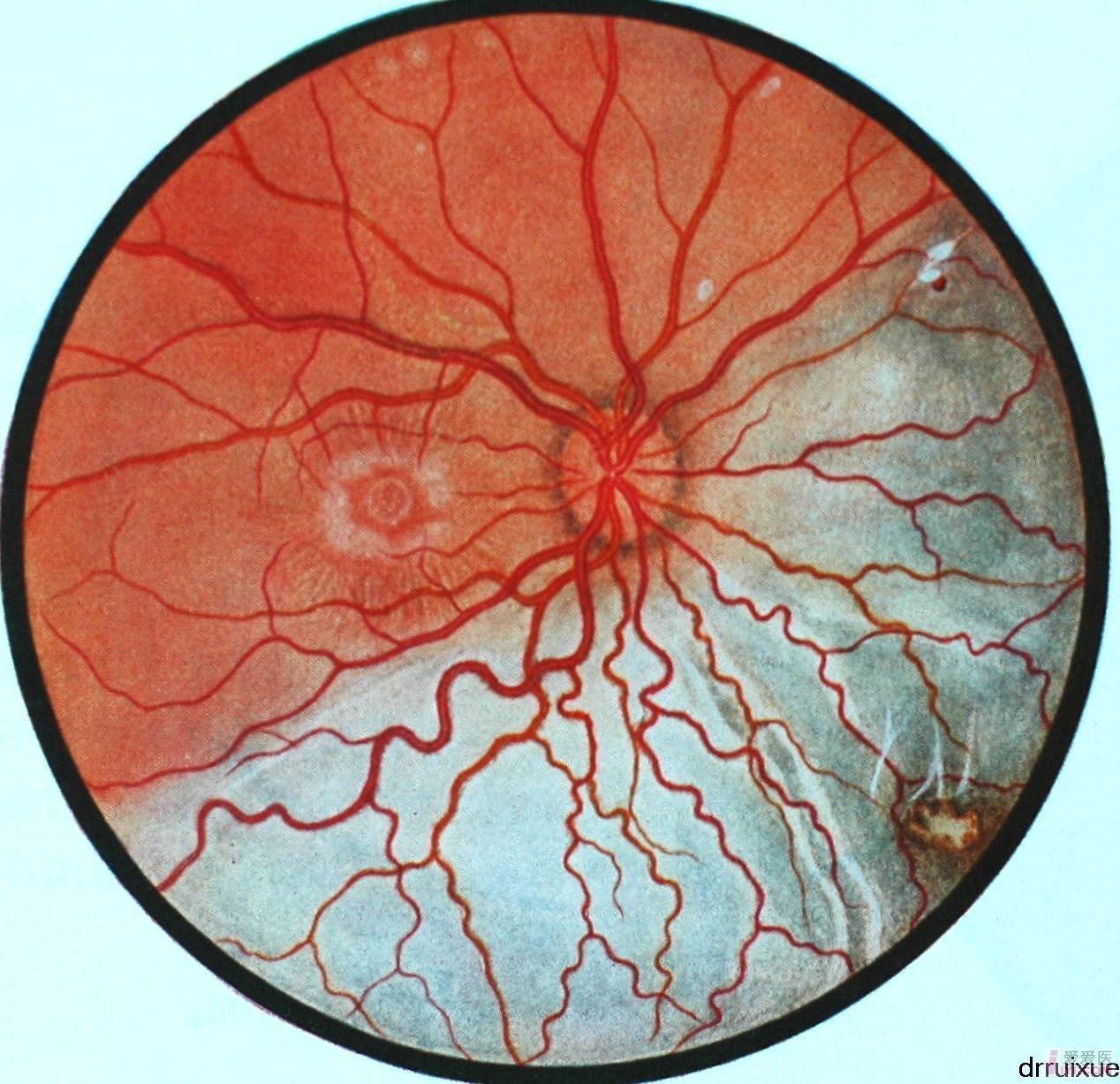 8.右眼球内异物继发性视网膜脱离.JPG