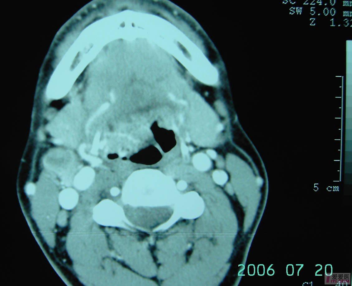 【原创】口咽部粘液表皮样癌颌颈根治术 斜方肌瓣术 - 口腔医学专业讨