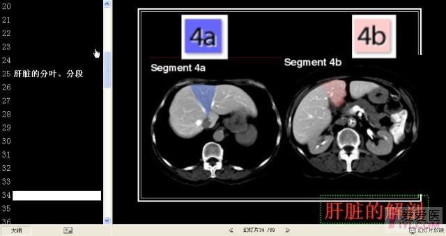 肝脏分段8段CT图谱图片